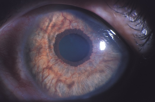 Vaisseaux anormaux visibles à la surface antérieure de l’iris, traduisant une néovascularisation irienne.