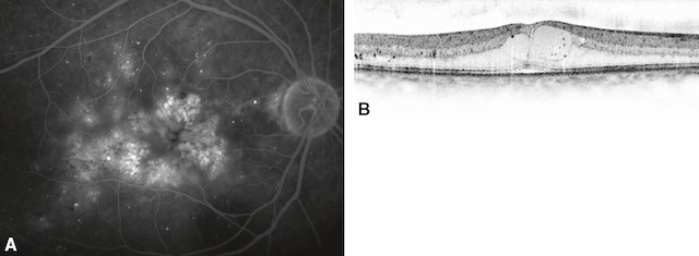 Œdème maculaire cystoïde marqué avec fuites vasculaires et cavités intrarétiniennes en coupe OCT.