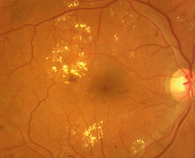 Œdème maculaire avec exsudats lipidiques en couronne autour de la macula.