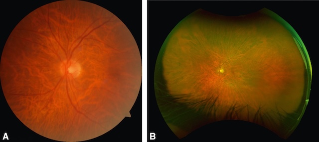 Rétine très vascularisée avec hypermyélinisation, vue centrale et périphérique.
