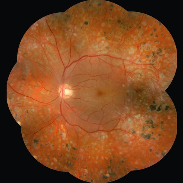 Multiples cicatrices de laser périphériques, épargnant la macula, post-photocoagulation panrétinienne.