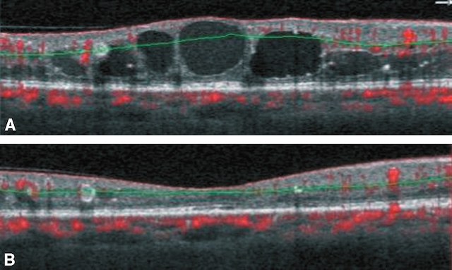Œdème maculaire initial résolu après traitement anti-VEGF avec régression des kystes rétiniens.