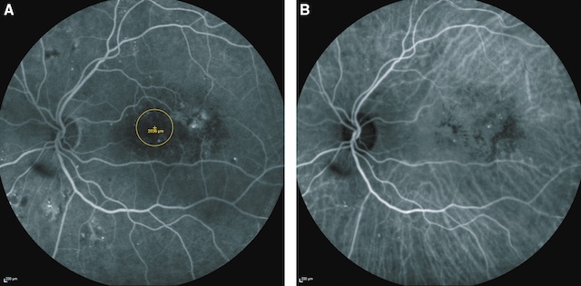 Fuite fluorescéinique diffuse d’un œdème maculaire diabétique avec imprégnation centrale progressive.