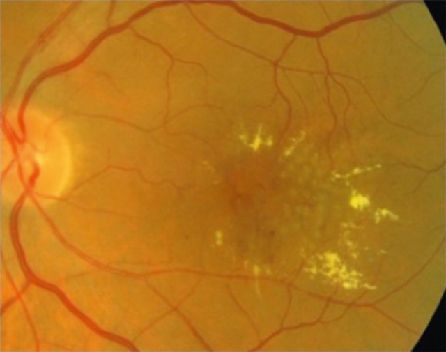 Macula épaissie post-laser avec exsudats lipidiques en couronne et traces focales visibles.