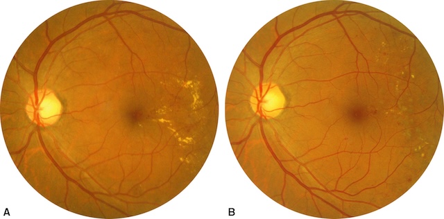 Régression partielle de l’œdème maculaire diabétique après photocoagulation focale.