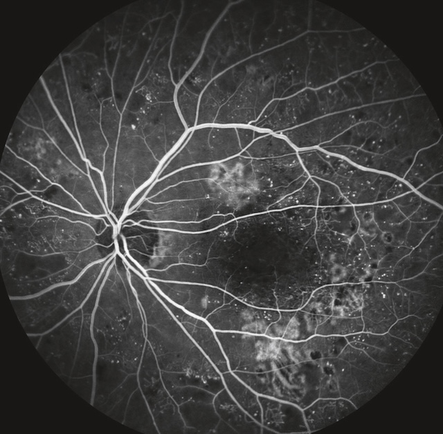 Angiographie montrant œdème maculaire avec fuites actives et zones d’ischémie capillaire.