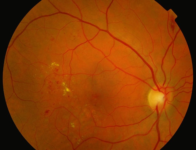 Maculopathie diabétique avec exsudats lipidiques en anneau et hémorragies rétiniennes diffuses.
