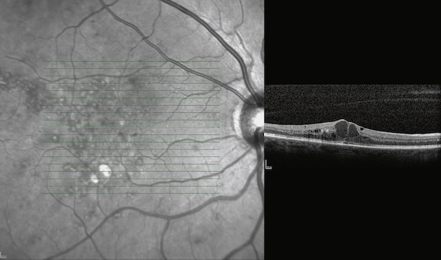 Œdème maculaire cystoïde avec multiples cavités intra-rétiniennes visibles en coupe OCT.
