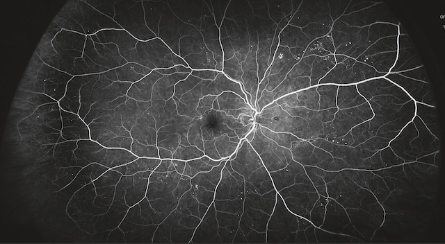 Microanévrismes diffus et fuite périfovéolaire sans néovaisseaux sur angiographie fluorescéinique.