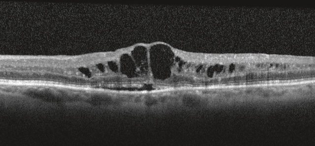 Œdème maculaire cystoïde avec cavités intrarétiniennes bien définies au niveau fovéal.
