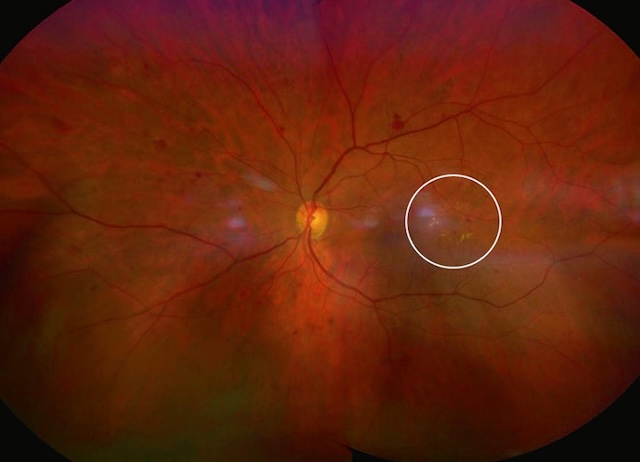 Zone focale d’exsudats lipidiques avec microanévrismes sur fond de rétinopathie diabétique.