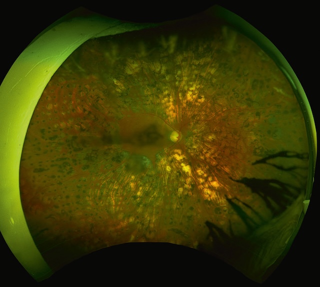 Rétinopathie diabétique sévère traitée avec photocoagulation panrétinienne extensive.