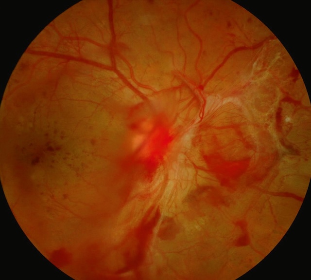 Hémorragie prérétinienne et membranes fibrovasculaires sur rétinopathie diabétique proliférante.