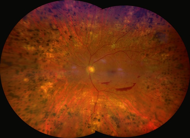 Rétinopathie diabétique proliférante cicatricielle avec hémorragie prérétinienne et photocoagulation panrétinienne étendue.