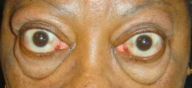 Exophtalmie bilatérale inflammatoire compatible avec une orbitopathie de Basedow active.