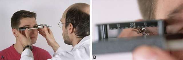 Mesure précise de l’exophtalmie avec l’ophtalmomètre de Hertel.