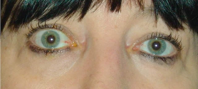 Rétraction palpébrale supérieure droite sans exophtalmie, évocatrice de Basedow.