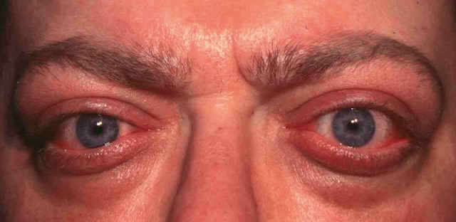 Œdème palpébral inflammatoire asymétrique, rougeur et tension cutanée marquées.