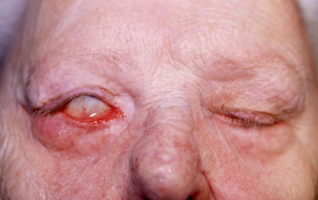 Lagophtalmie gauche avec cornée exposée, œdème palpébral et rougeur localisée.