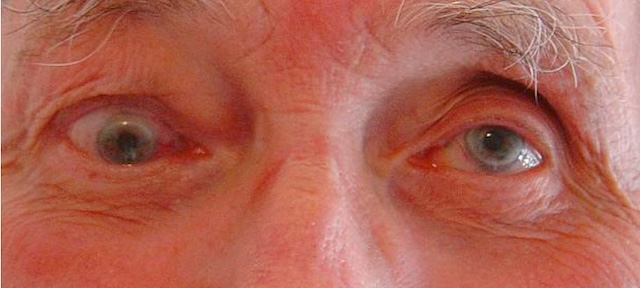 Désalignement oculaire discret évoquant une atteinte motrice orbitopathique.