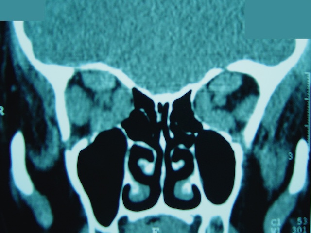 Épaississement musculaire orbitaire en contact avec les nerfs optiques, évoquant une orbitopathie compressive.