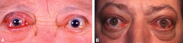 Inflammation orbitopathique active bilatérale nécessitant traitement anti-inflammatoire.